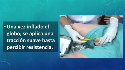 sonda vesical mujer real|Inserción de sondaje vesical temporal o permanente en la mujer ...